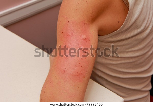 Allergy Skin\
Testing