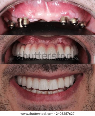 All-on-four implant treatment. Visuals of aesthetic smile design with porcelain dental prosthesis before and after. Images illustrating the stages of 