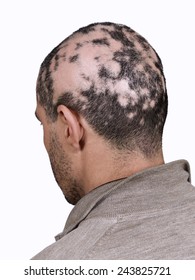 Alopecia