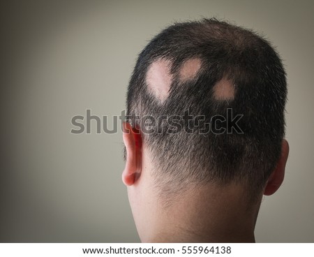 Alopecia Aerata