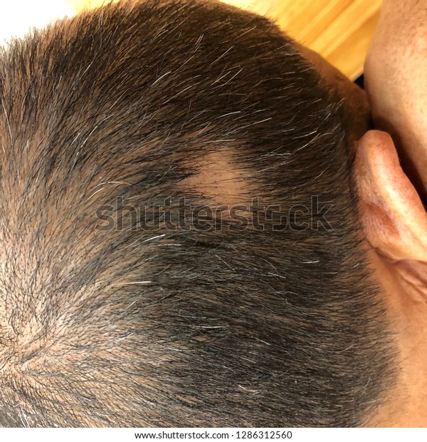 Alopecia Areata One Type Skin Disease Stock Photo Edit Now