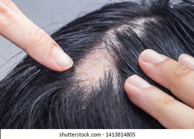 Alopecia Areata - Spot Baldness 