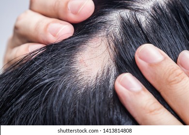 Alopecia Areata - Spot Baldness 