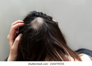 Alopecia And Gray Hair On The Head Of A Woman. Stress And Ill Helth. Close-up. Gray Background.