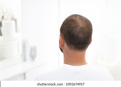 Alopecia. The Head Of A Man With Thinning Hair