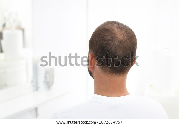 Alopecia Head Man Thinning Hair Stock Photo Edit Now 1092674957