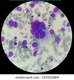 Alveolar Rhabdomyosarcoma Is A Sub-type Of The Rhabdomyosarcoma Soft Tissue Cancer Family Whose Lineage Is From Mesenchymal Cells And Are Related To Skeletal Muscle Cells.