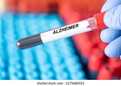 Alzheimer. Alzheimer Disease Blood Test In Doctor Hand