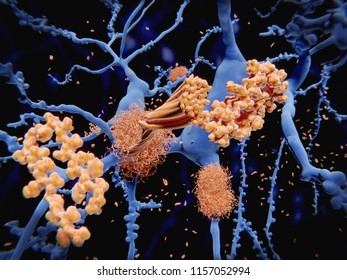 Alzheimer's disease: the amyloid-beta peptide accumulates to amyloid fibrils that build up dense amyloid plaques. 3d rendering
