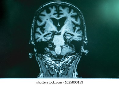 alzheimer's disease with MRI