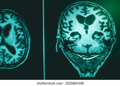 Alzheimer's Disease On Film MRI Hippocampus Atrophy 