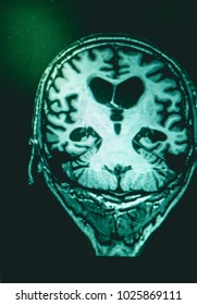 Alzheimer's Disease On Film MRI Hippocampus Atrophy 