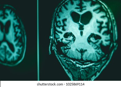 Alzheimer's Disease On Film MRI Hippocampus Atrophy 