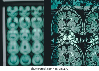 Alzheimer's Disease On MRI 2