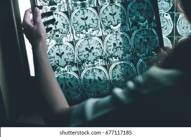 Alzheimer's Disease On MRI