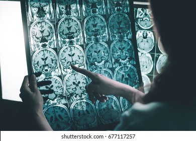 alzheimer's disease on MRI
