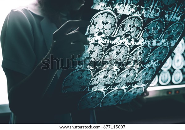 alzheimer\'s disease on\
MRI