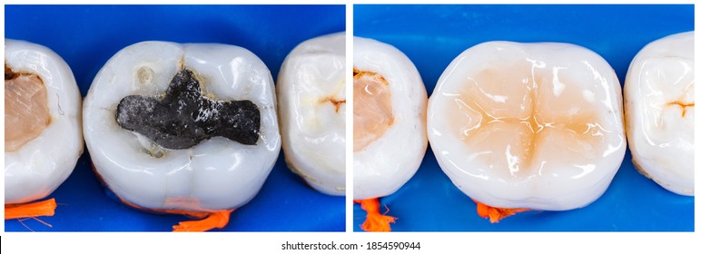 Amalgam (Mercury) filling replacing with ligt cure composite after root canal treatment