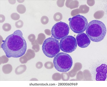 AML (Flow cytometric analysis identifies an increased abnormal population in the monocytic region, accounting for approximately 88.80% of all events. this population expresses CD13, CD33, CD117, HLA-DR, CD4, CD123, CD45R4 and CD56. CD64 is inconclusive. It is negative for CD34, CD19, CD20, CD7, CD3, cytoplasmic CD3, PAX5, cytoplasmic CD79a and cytoplasmic CD22.)
