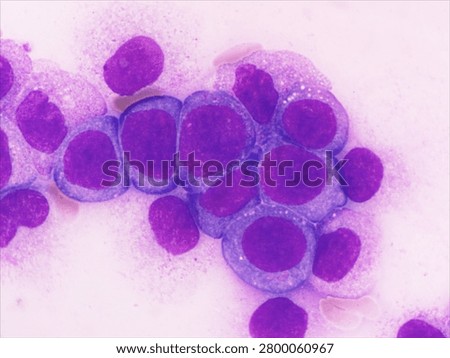 AML (Flow cytometric analysis identifies an increased abnormal population in the monocytic region, accounting for approximately 88.80% of all events. this population expresses CD13, CD33, CD117, HLA-DR, CD4, CD123, CD45R4 and CD56. CD64 is inconclusive. It is negative for CD34, CD19, CD20, CD7, CD3, cytoplasmic CD3, PAX5, cytoplasmic CD79a and cytoplasmic CD22.)