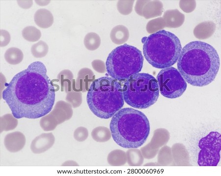 AML (Flow cytometric analysis identifies an increased abnormal population in the monocytic region, accounting for approximately 88.80% of all events. this population expresses CD13, CD33, CD117, HLA-DR, CD4, CD123, CD45R4 and CD56. CD64 is inconclusive. It is negative for CD34, CD19, CD20, CD7, CD3, cytoplasmic CD3, PAX5, cytoplasmic CD79a and cytoplasmic CD22.)