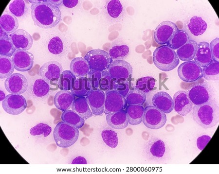 AML (Flow cytometric analysis identifies an increased abnormal population in the monocytic region, accounting for approximately 88.80% of all events. this population expresses CD13, CD33, CD117, HLA-DR, CD4, CD123, CD45R4 and CD56. CD64 is inconclusive. It is negative for CD34, CD19, CD20, CD7, CD3, cytoplasmic CD3, PAX5, cytoplasmic CD79a and cytoplasmic CD22.)