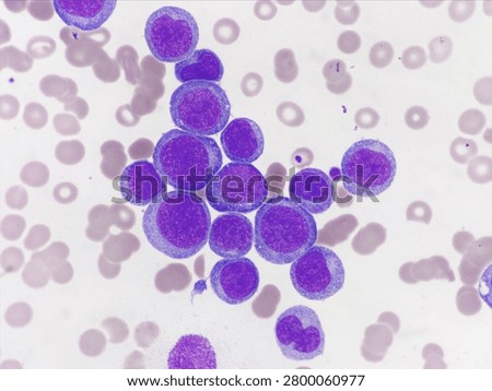 AML (Flow cytometric analysis identifies an increased abnormal population in the monocytic region, accounting for approximately 88.80% of all events. this population expresses CD13, CD33, CD117, HLA-DR, CD4, CD123, CD45R4 and CD56. CD64 is inconclusive. It is negative for CD34, CD19, CD20, CD7, CD3, cytoplasmic CD3, PAX5, cytoplasmic CD79a and cytoplasmic CD22.)