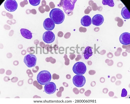 AML (Flow cytometric analysis identifies an increased abnormal population in the monocytic region, accounting for approximately 88.80% of all events. this population expresses CD13, CD33, CD117, HLA-DR, CD4, CD123, CD45R4 and CD56. CD64 is inconclusive. It is negative for CD34, CD19, CD20, CD7, CD3, cytoplasmic CD3, PAX5, cytoplasmic CD79a and cytoplasmic CD22.)