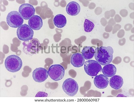 AML (Flow cytometric analysis identifies an increased abnormal population in the monocytic region, accounting for approximately 88.80% of all events. this population expresses CD13, CD33, CD117, HLA-DR, CD4, CD123, CD45R4 and CD56. CD64 is inconclusive. It is negative for CD34, CD19, CD20, CD7, CD3, cytoplasmic CD3, PAX5, cytoplasmic CD79a and cytoplasmic CD22.)