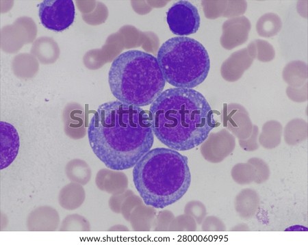 AML (Flow cytometric analysis identifies an increased abnormal population in the monocytic region, accounting for approximately 88.80% of all events. this population expresses CD13, CD33, CD117, HLA-DR, CD4, CD123, CD45R4 and CD56. CD64 is inconclusive. It is negative for CD34, CD19, CD20, CD7, CD3, cytoplasmic CD3, PAX5, cytoplasmic CD79a and cytoplasmic CD22.)