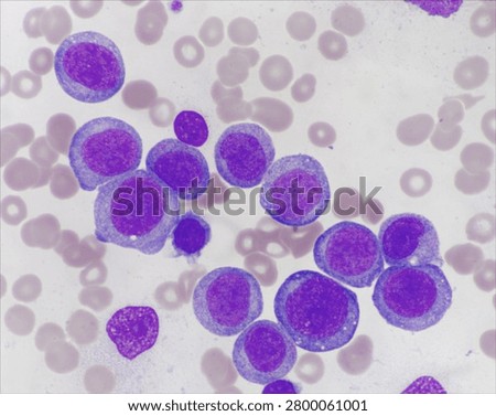 AML (Flow cytometric analysis identifies an increased abnormal population in the monocytic region, accounting for approximately 88.80% of all events. this population expresses CD13, CD33, CD117, HLA-DR, CD4, CD123, CD45R4 and CD56. CD64 is inconclusive. It is negative for CD34, CD19, CD20, CD7, CD3, cytoplasmic CD3, PAX5, cytoplasmic CD79a and cytoplasmic CD22.)