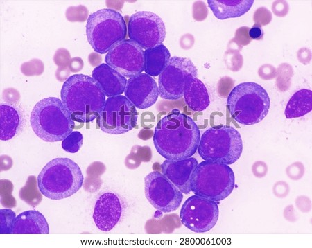 AML (Flow cytometric analysis identifies an increased abnormal population in the monocytic region, accounting for approximately 88.80% of all events. this population expresses CD13, CD33, CD117, HLA-DR, CD4, CD123, CD45R4 and CD56. CD64 is inconclusive. It is negative for CD34, CD19, CD20, CD7, CD3, cytoplasmic CD3, PAX5, cytoplasmic CD79a and cytoplasmic CD22.)