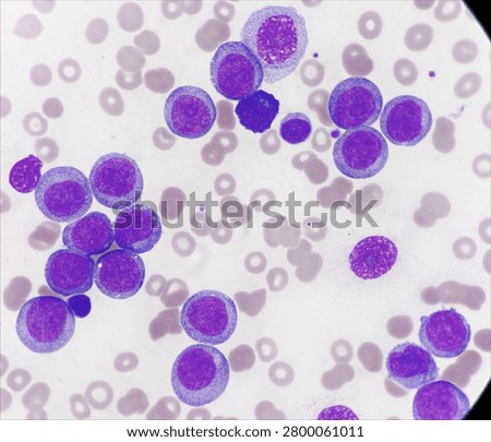 AML (Flow cytometric analysis identifies an increased abnormal population in the monocytic region, accounting for approximately 88.80% of all events. this population expresses CD13, CD33, CD117, HLA-DR, CD4, CD123, CD45R4 and CD56. CD64 is inconclusive. It is negative for CD34, CD19, CD20, CD7, CD3, cytoplasmic CD3, PAX5, cytoplasmic CD79a and cytoplasmic CD22.)