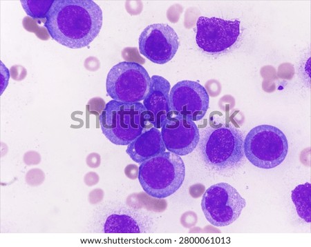 AML (Flow cytometric analysis identifies an increased abnormal population in the monocytic region, accounting for approximately 88.80% of all events. this population expresses CD13, CD33, CD117, HLA-DR, CD4, CD123, CD45R4 and CD56. CD64 is inconclusive. It is negative for CD34, CD19, CD20, CD7, CD3, cytoplasmic CD3, PAX5, cytoplasmic CD79a and cytoplasmic CD22.)