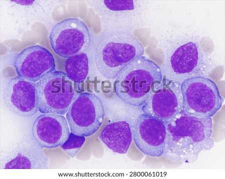 AML (Flow cytometric analysis identifies an increased abnormal population in the monocytic region, accounting for approximately 88.80% of all events. this population expresses CD13, CD33, CD117, HLA-DR, CD4, CD123, CD45R4 and CD56. CD64 is inconclusive. It is negative for CD34, CD19, CD20, CD7, CD3, cytoplasmic CD3, PAX5, cytoplasmic CD79a and cytoplasmic CD22.)