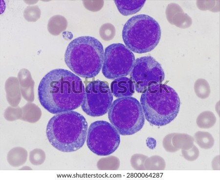 AML (Flow cytometric analysis identifies an increased abnormal population in the monocytic region, accounting for approximately 88.80% of all events. This population expresses CD13, CD33, CD117, HLA-DR, CD4, CD123, CD45R4 and CD56. CD64 is inconclusive. It is negative for CD34, CD19, CD20, CD7, CD3, cytoplasmic CD3, PAX5, cytoplasmic CD79a and cytoplasmic CD22.)