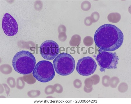 AML (Flow cytometric analysis identifies an increased abnormal population in the monocytic region, accounting for approximately 88.80% of all events. This population expresses CD13, CD33, CD117, HLA-DR, CD4, CD123, CD45R4 and CD56. CD64 is inconclusive. It is negative for CD34, CD19, CD20, CD7, CD3, cytoplasmic CD3, PAX5, cytoplasmic CD79a and cytoplasmic CD22.)