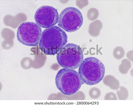 AML (Flow cytometric analysis identifies an increased abnormal population in the monocytic region, accounting for approximately 88.80% of all events. This population expresses CD13, CD33, CD117, HLA-DR, CD4, CD123, CD45R4 and CD56. CD64 is inconclusive. It is negative for CD34, CD19, CD20, CD7, CD3, cytoplasmic CD3, PAX5, cytoplasmic CD79a and cytoplasmic CD22.)