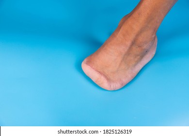 Leg Amputation High Res Stock Images Shutterstock