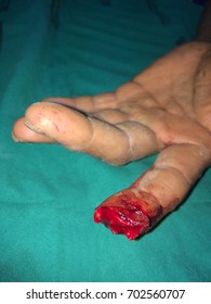 Amputation Wound At Left Distal Index Finger.