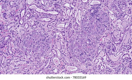 Amyloid Deposits In The Glomeruli Of Kidney (amyloidosis)