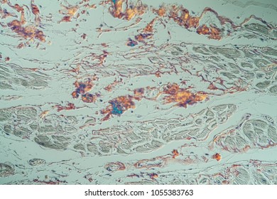 Amyloid Deposits In The Heart Under The Microscope