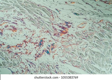 Amyloid Deposits In The Heart Under The Microscope