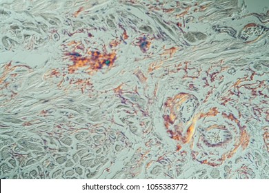 Amyloid Deposits In The Heart Under The Microscope