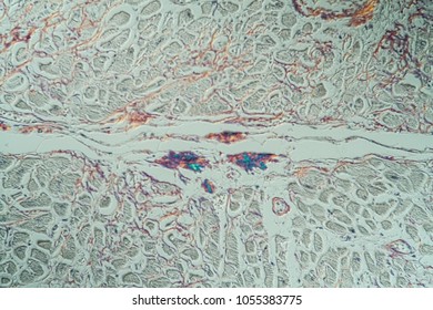 Amyloid Deposits In The Heart Under The Microscope