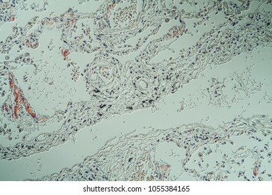 Amyloid Deposits In The Lungs Under The Microscope