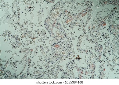 Amyloid Deposits In The Lungs Under The Microscope