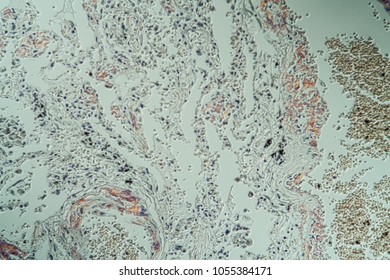 Amyloid Deposits In The Lungs Under The Microscope