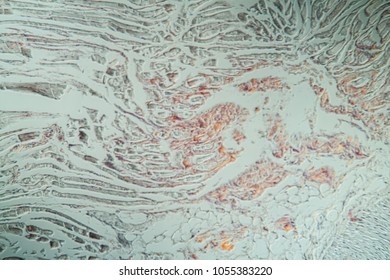 Amyloid Deposits In The Tongue Under The Microscope