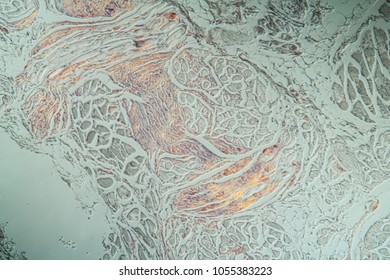 Amyloid Deposits In The Tongue Under The Microscope